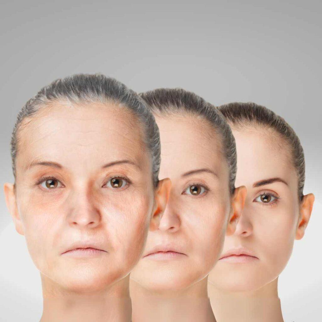 Sagging skin with ageing - Wrinkles on face and Fine lines
