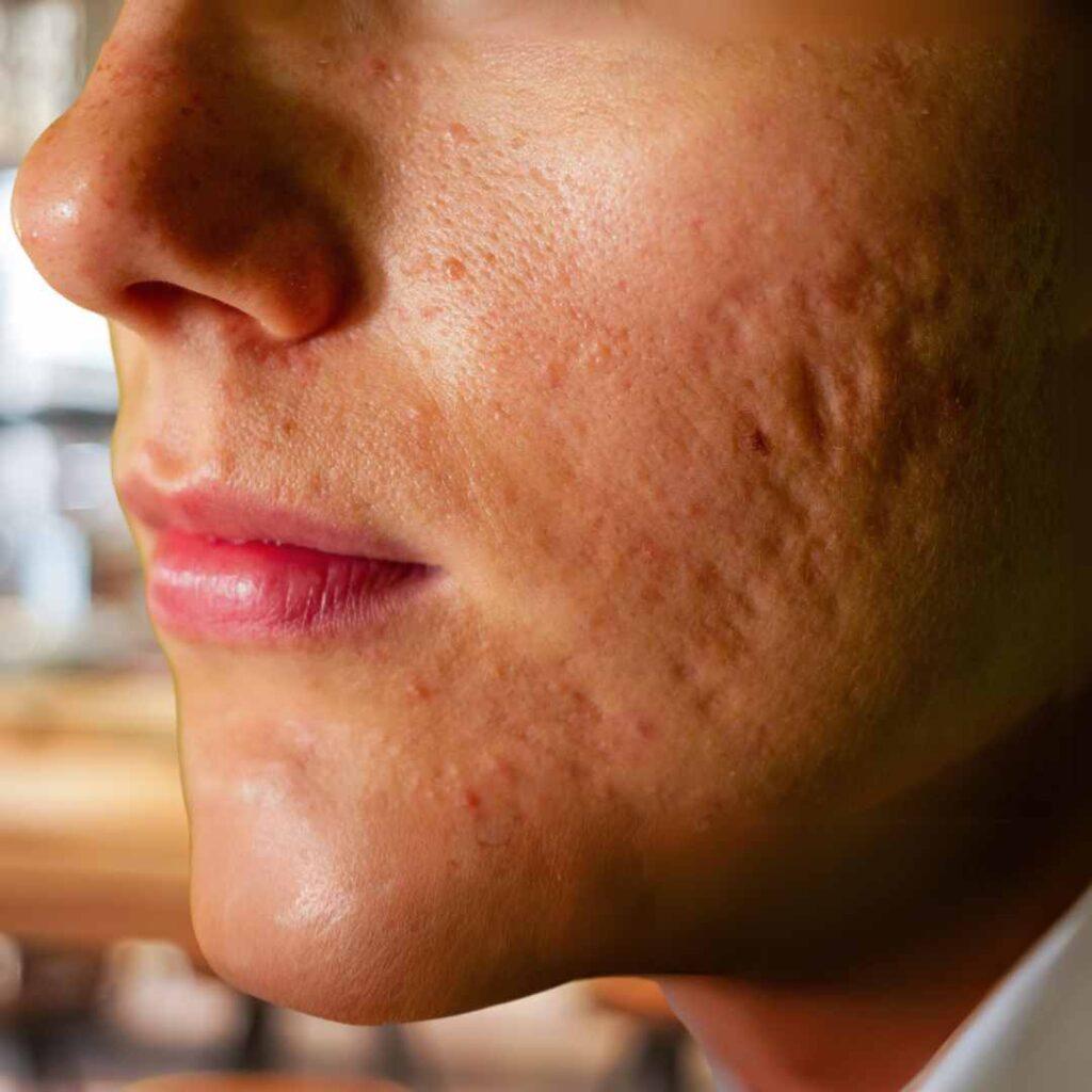 Acne Scars Treatment in Udaipur - CO2 laser, CIT, PRP, TCA CROSS
