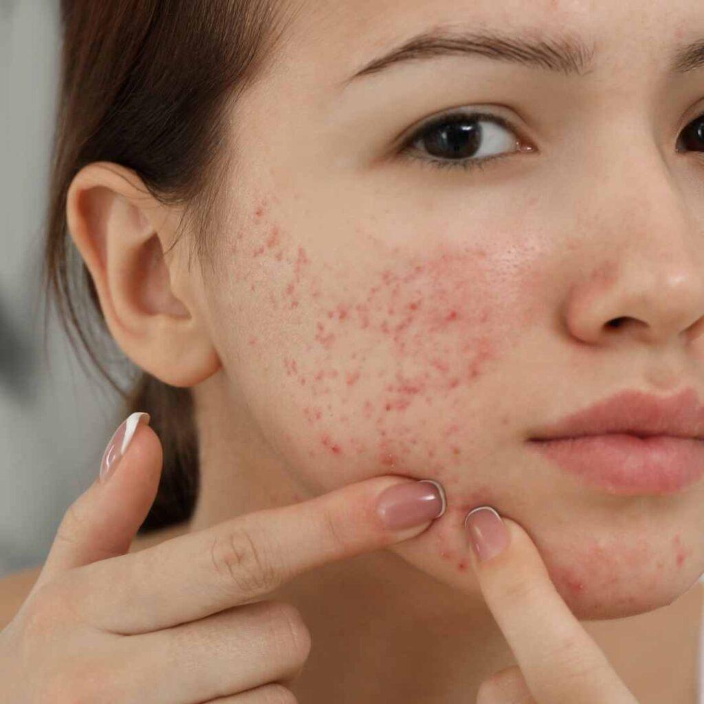 Acne and pimples Treatment in Udaipur - Tips, Treatment, FAQs