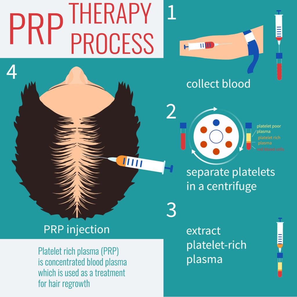 PRP Therapy in Udaipur for Hair Loss