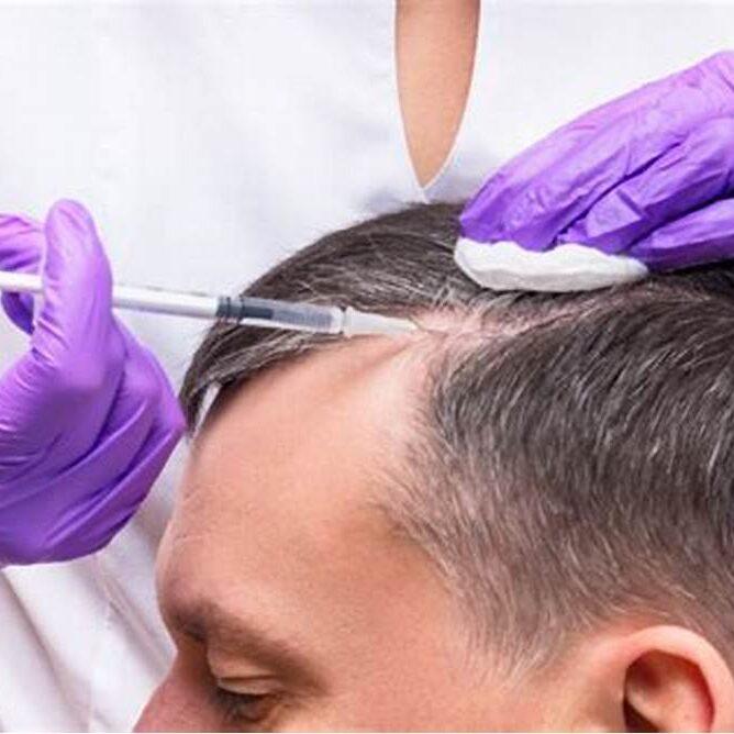 PRP therapy in Udaipur for Hair Loss - Cost and Benefits