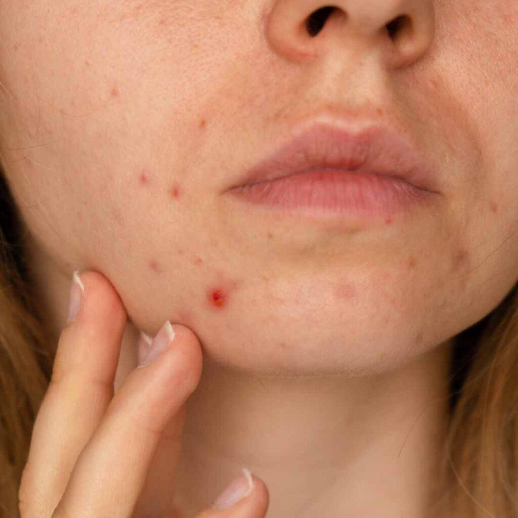 Skin Pigmentation due to Pimples - Acne Spots treatment in Udaipur