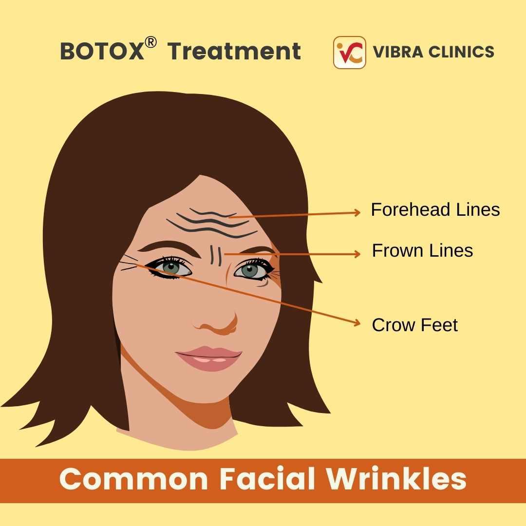 Botox Treatment in Udaipur for Wrinkles on Face