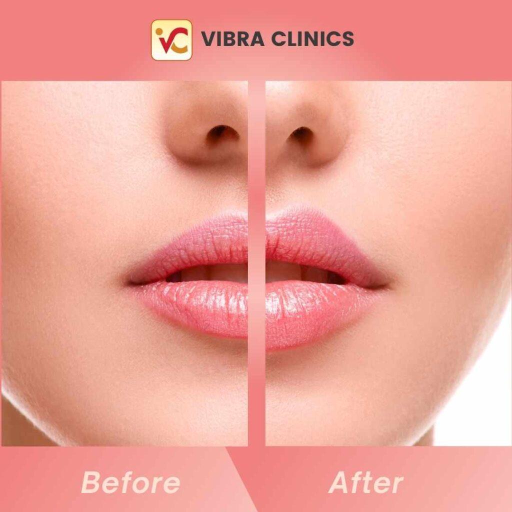Lip Filler in Udaipur - Lip Augmentation