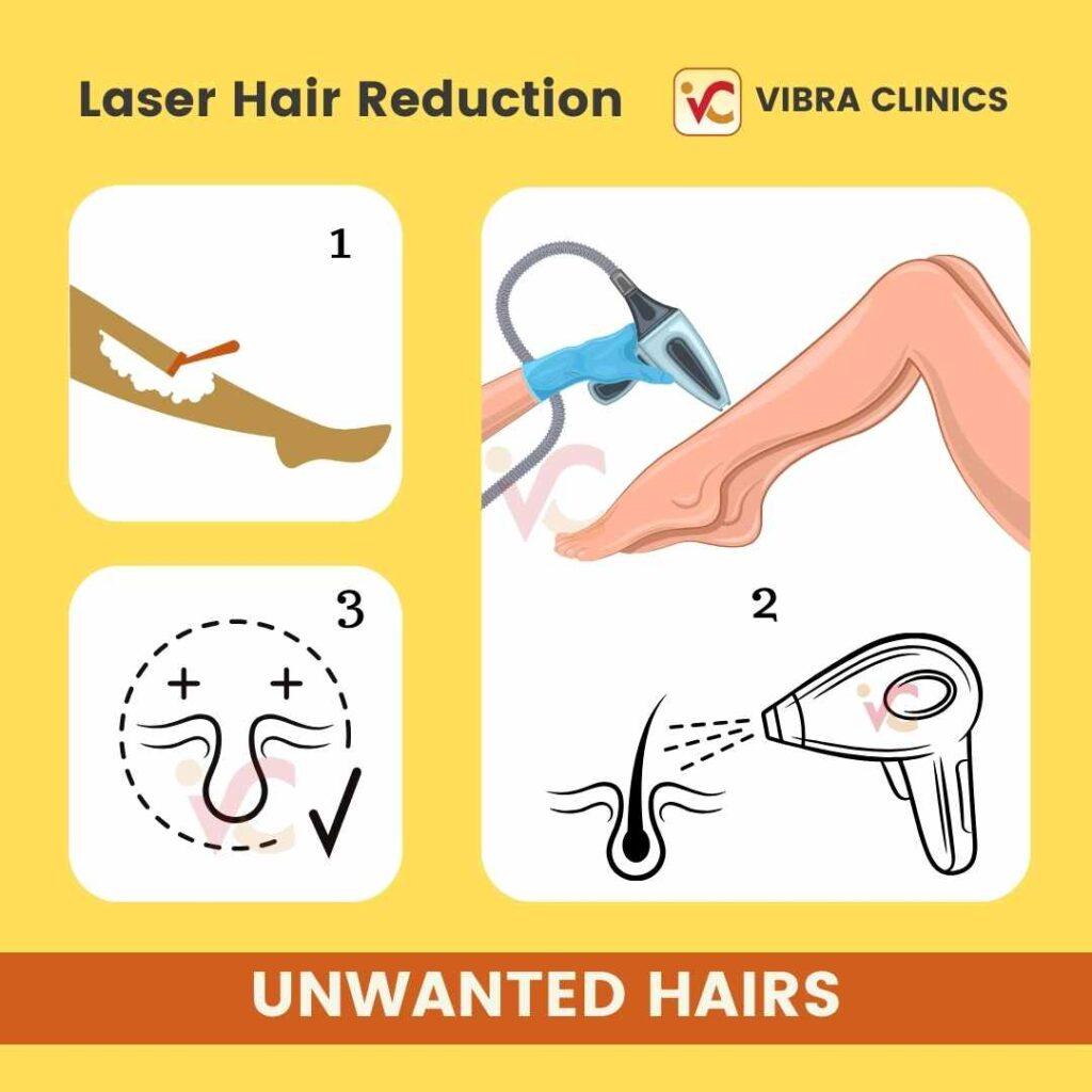 Laser Hair Removal in Udaipur - Affordable, Painless and Highly Effective