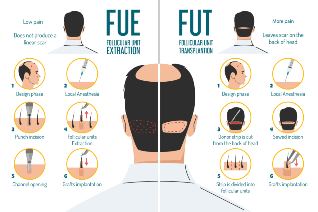 FUE v/s FUT Hair Transplant in Udaipur - Benefits and Outcome