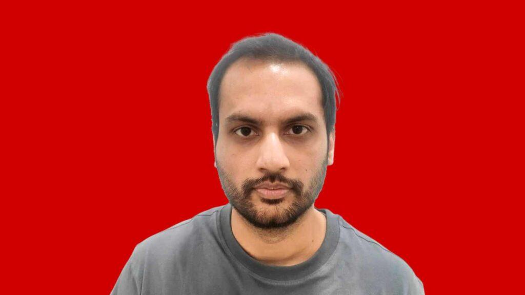 Best Hair Transplant in Udaipur