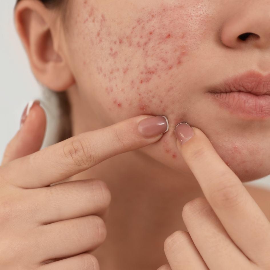 Young woman receiving professional acne and scar treatment at Vibra Clinics to clear skin and reduce blemishes.