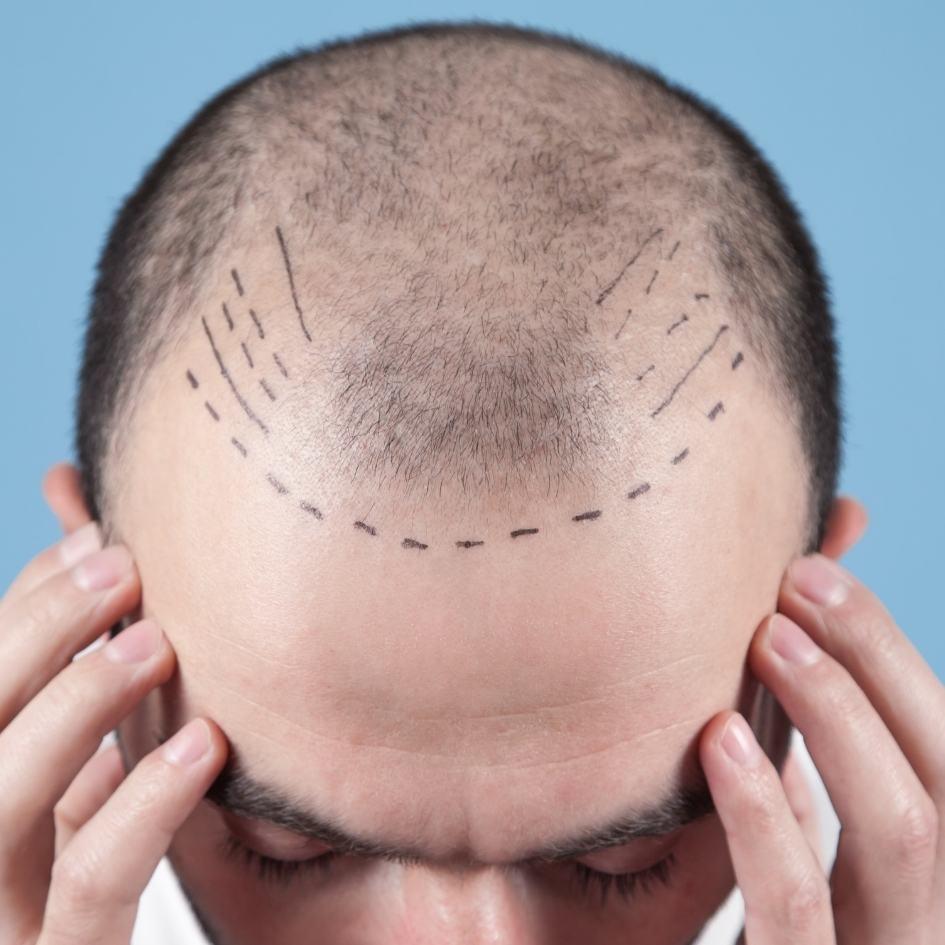 Hair transplant procedure using FUE technique at Vibra Clinics, restoring natural hairline with minimally invasive care.