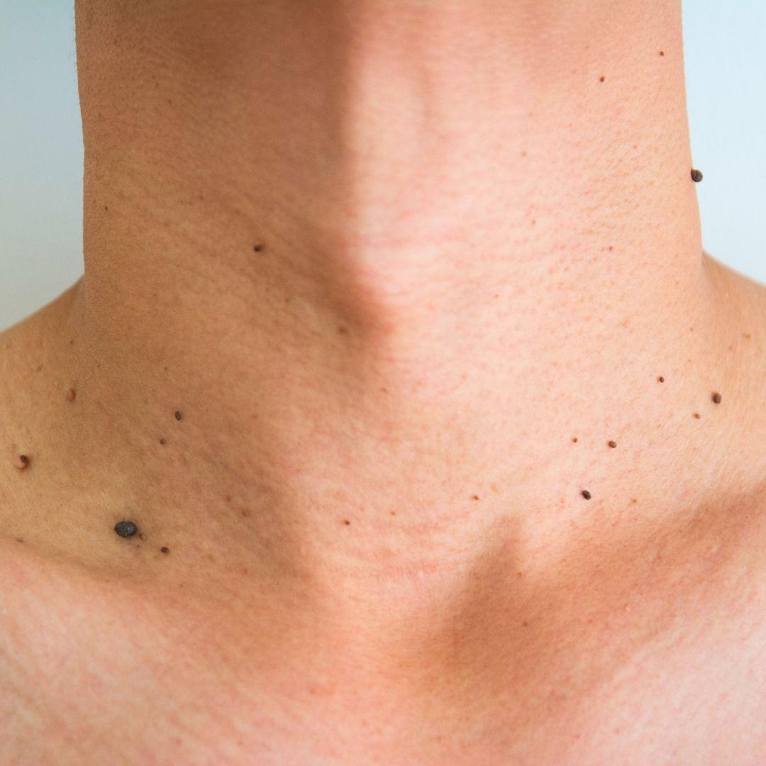 Close-up of a dermatologist performing mole and skin tag removal on a patient at Vibra Clinics, Udaipur