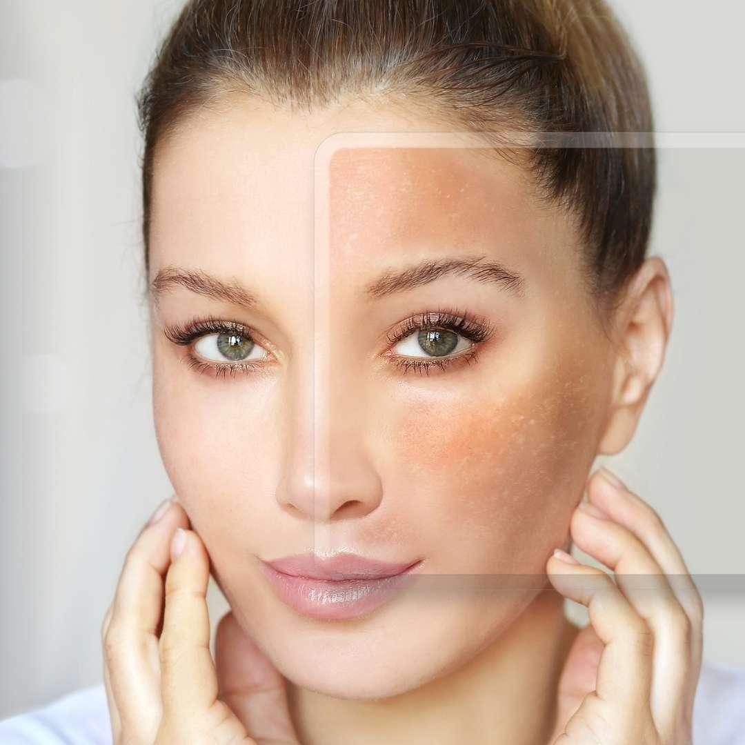 Close-up of a woman’s face before and after pigmentation and dark spot treatment at Vibra Clinics, showing even-toned, clearer skin